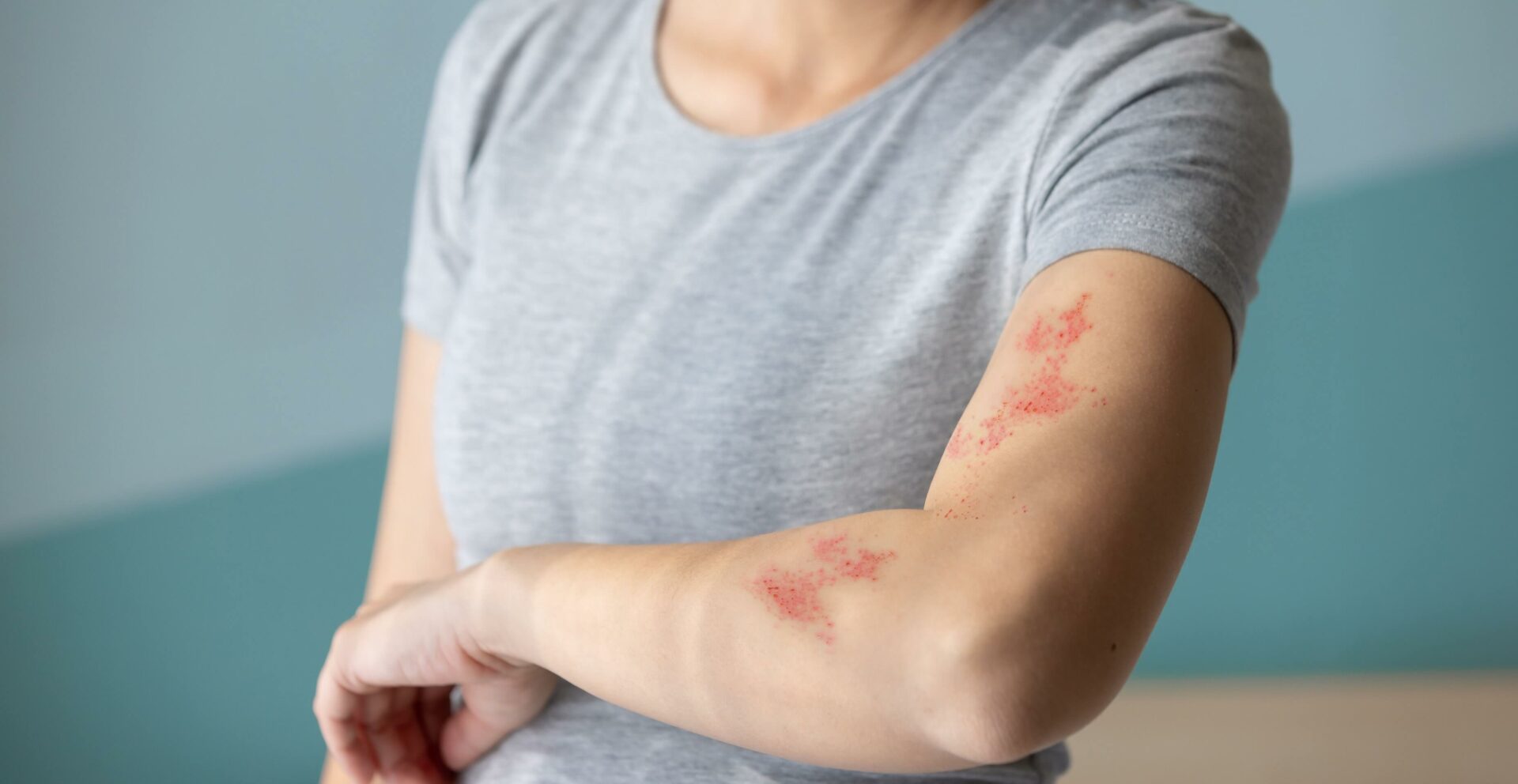 Frau begutachtet ihren Hautausschlag auf ihrem Arm