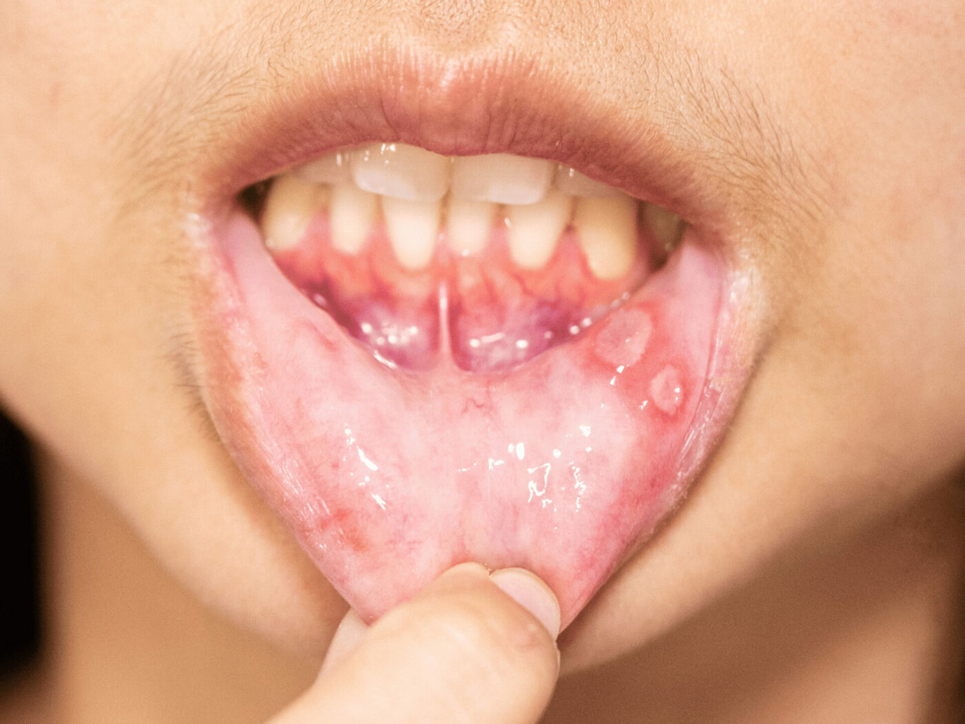 Person pulls down lower lip depicting mouth inflammation